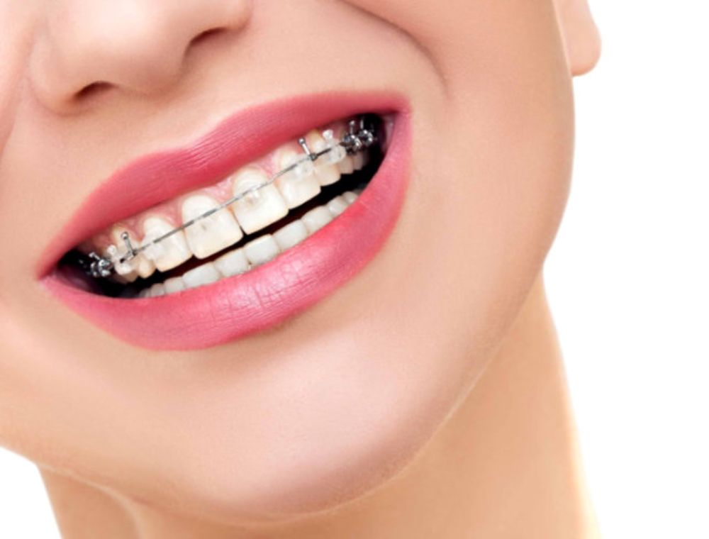 Best Dentist In Rohini - All Dental Treatments, Teeth Straigntning Braces
